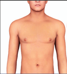 Gynecomastia – Male Breast Reduction Surgery Can Help You