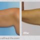 BodyTite - A Minimally Invasive Body Contouring Procedure - dr reno