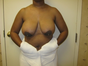 breast reduction surgery in hattiesburg - before photo