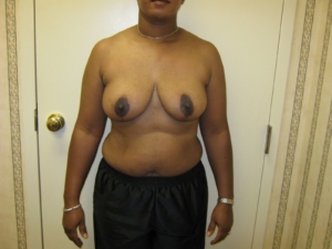 Breast Reduction Surgery In Hattiesburg - After Photo
