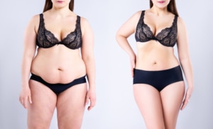 Before and after shot of woman who had post-weight-loss body lift surgery