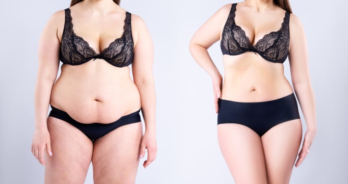 Before and after shot of woman who had post-weight-loss body lift surgery