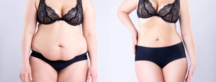 Before and after shot of woman who had post-weight-loss body lift surgery