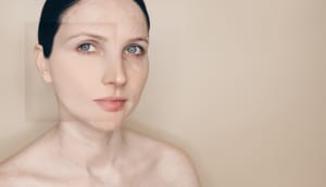 Before and after photo of woman with vascular skin problems, showing acne, rosacea, and couperose treatment results in cosmetology skincare