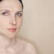 Before and after photo of woman with vascular skin problems, showing acne, rosacea, and couperose treatment results in cosmetology skincare