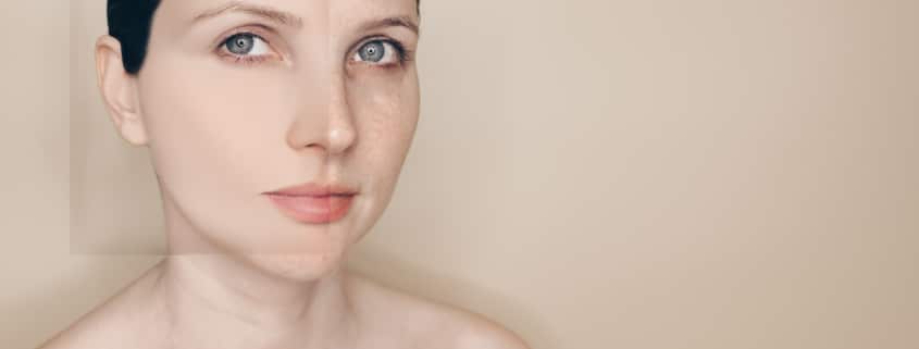 Before and after photo of woman with vascular skin problems, showing acne, rosacea, and couperose treatment results in cosmetology skincare