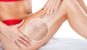 A close-up shot of spider veins on a woman's thigh