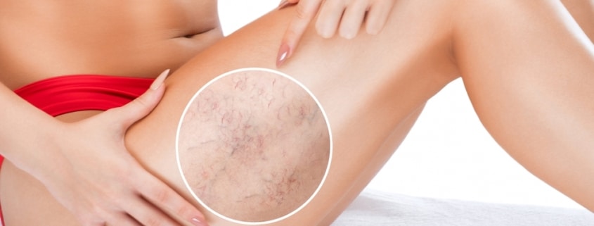 A close-up shot of spider veins on a woman's thigh