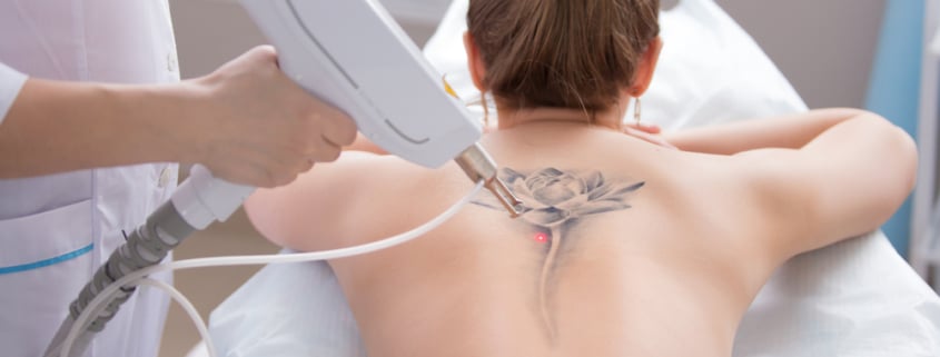 Woman has giant flower tattoo on her back removed by a doctor.